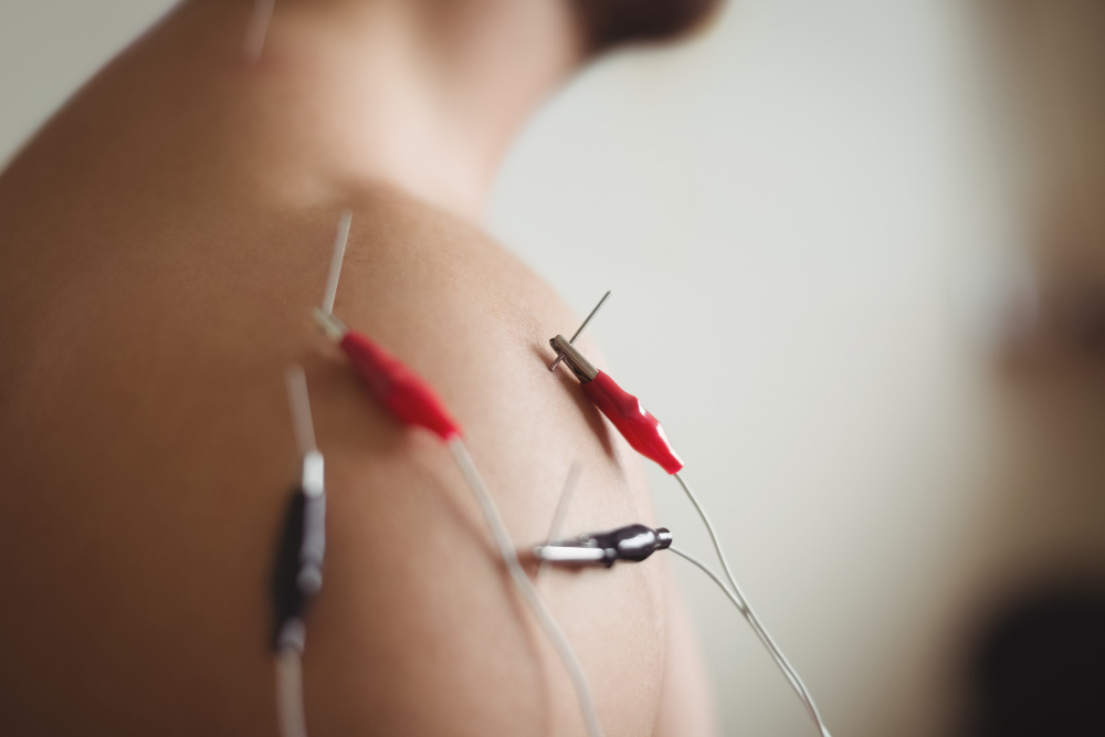 electro acupuncture done by acupuncture practitioners